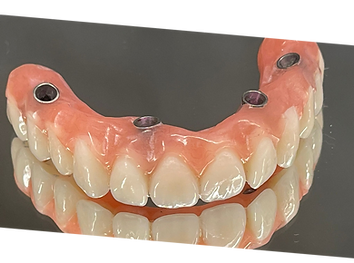 Upper Jaw Dental Implant
