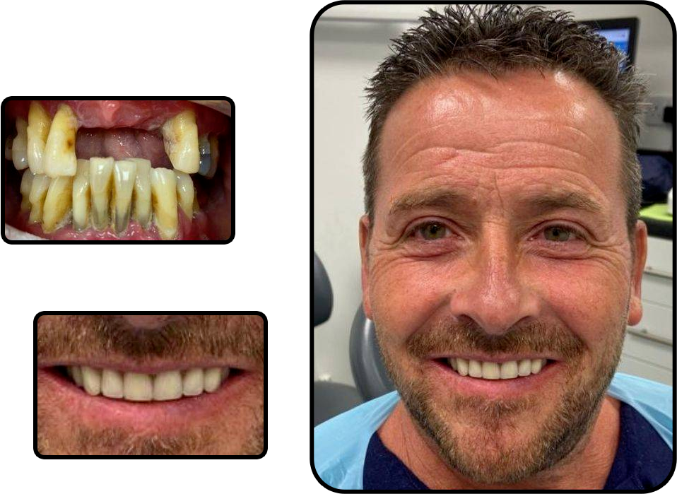 All on Four Dental Implant Before and After