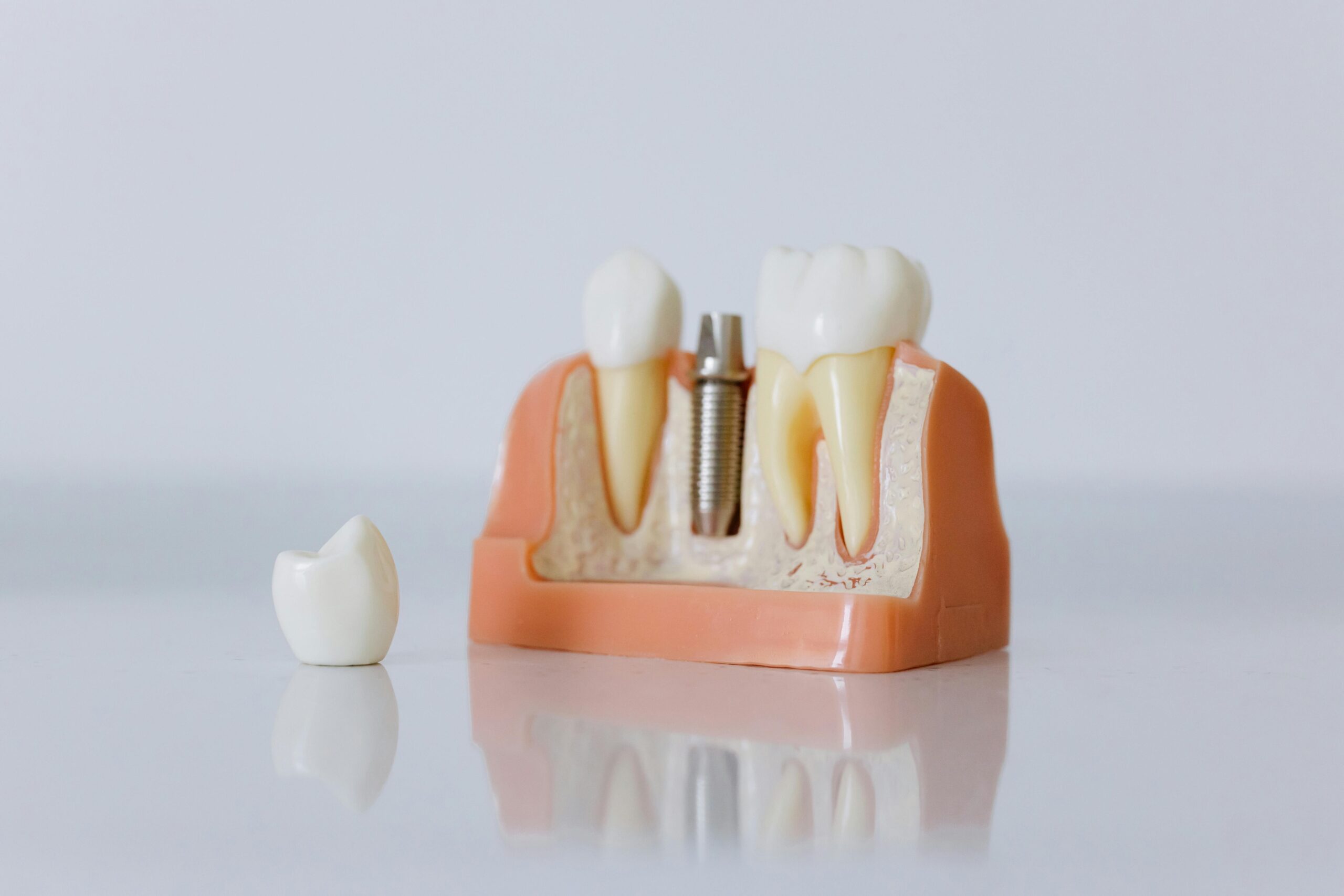 single tooth implants uk