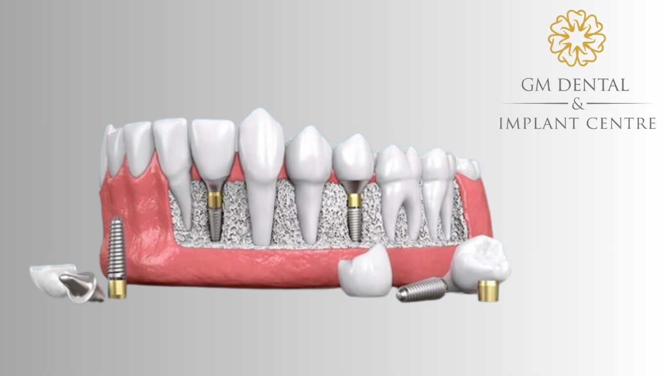 all on 4 dental implant