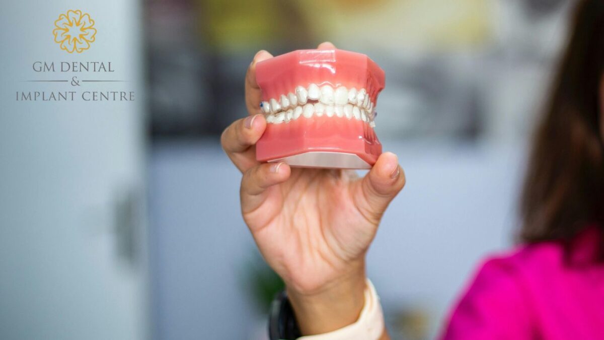 Overdentures vs. Implants