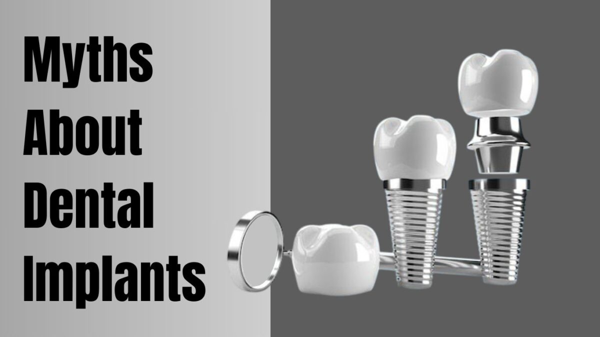 Myth about Dental Implant