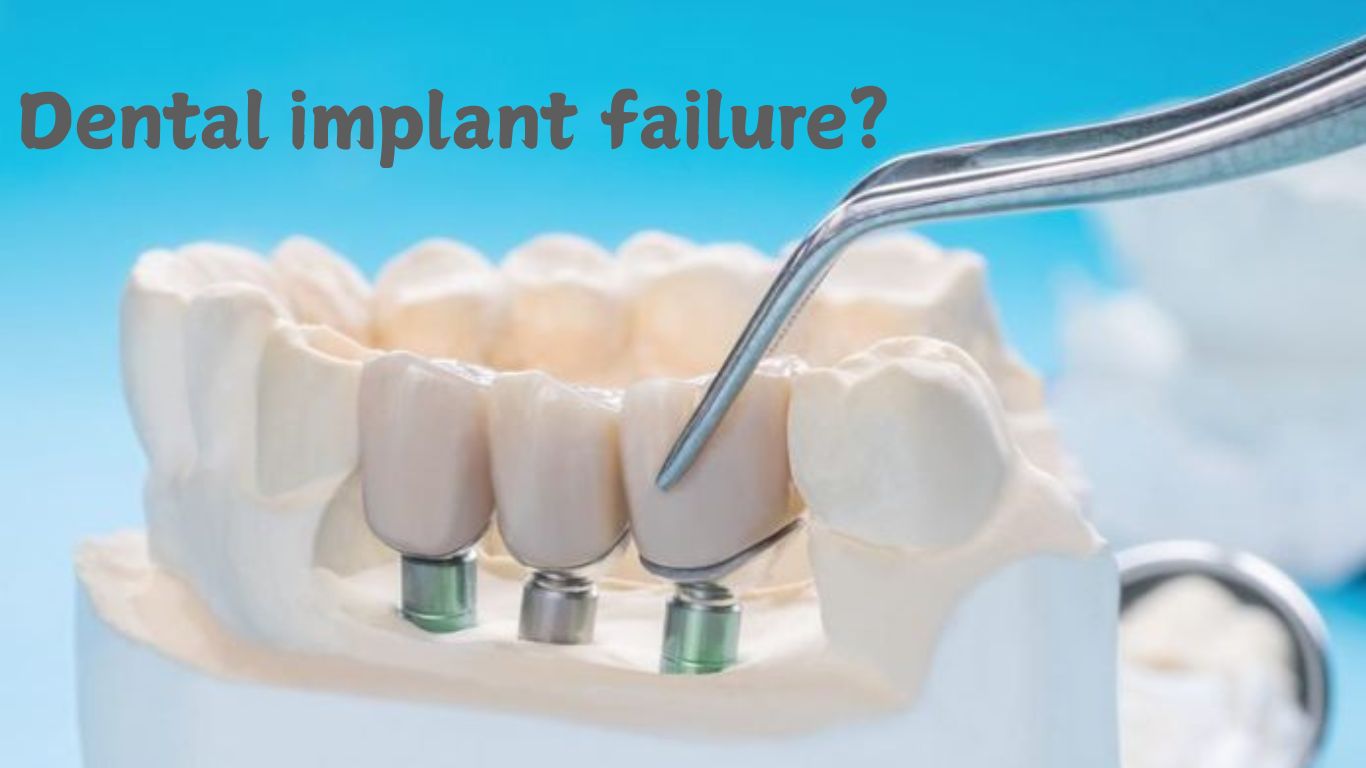 dental implant